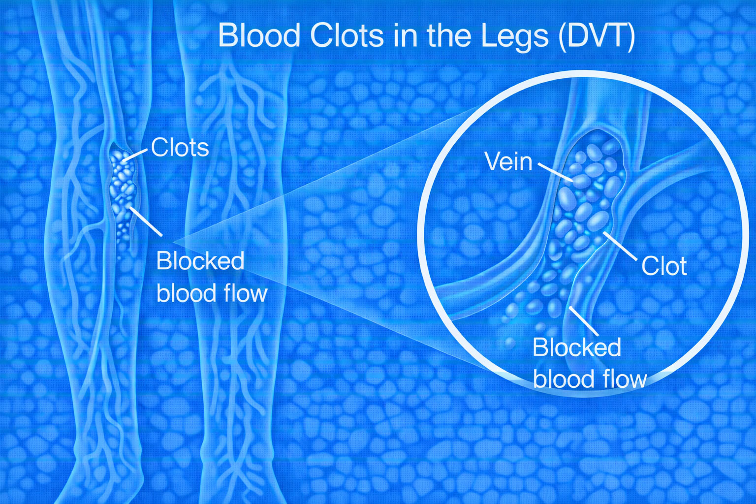 dvt treatment Chennai