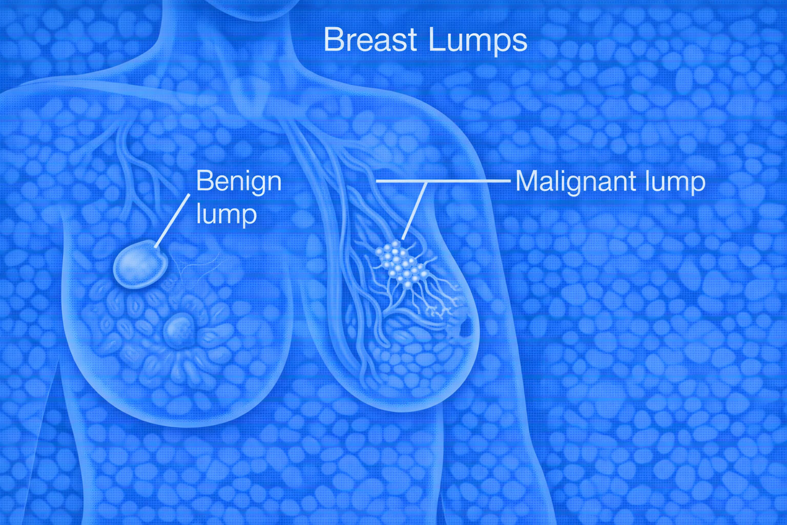 Breast Lump Treatment Chennai – Causes, Diagnosis & Treatment