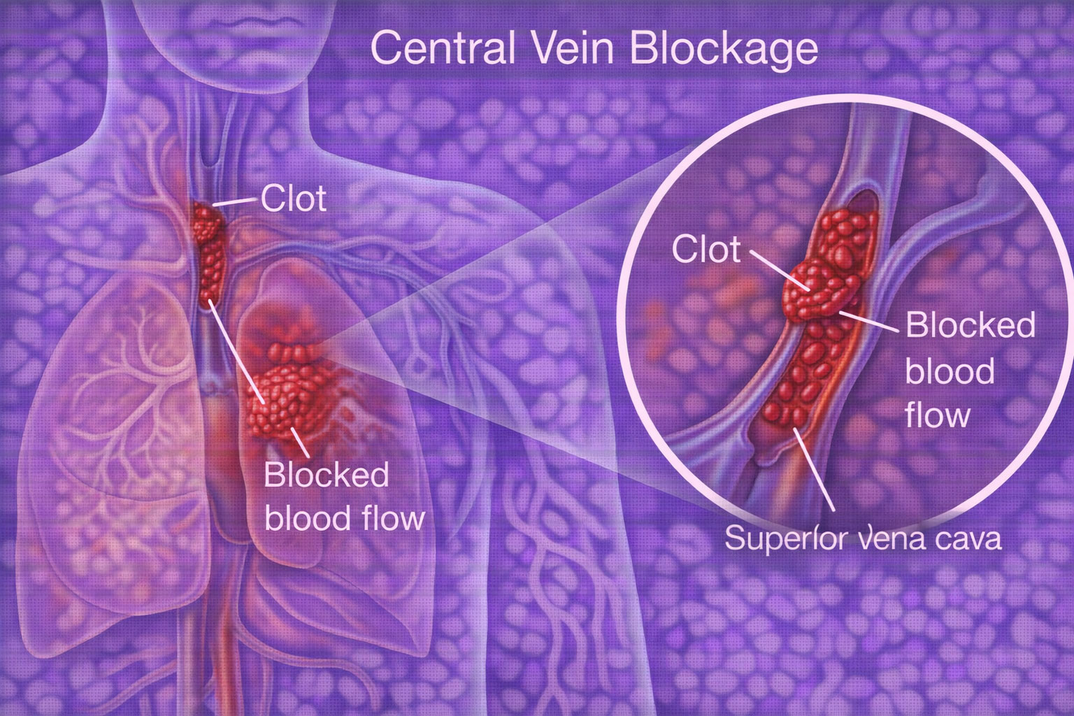 pulmonary avm embolization chennai