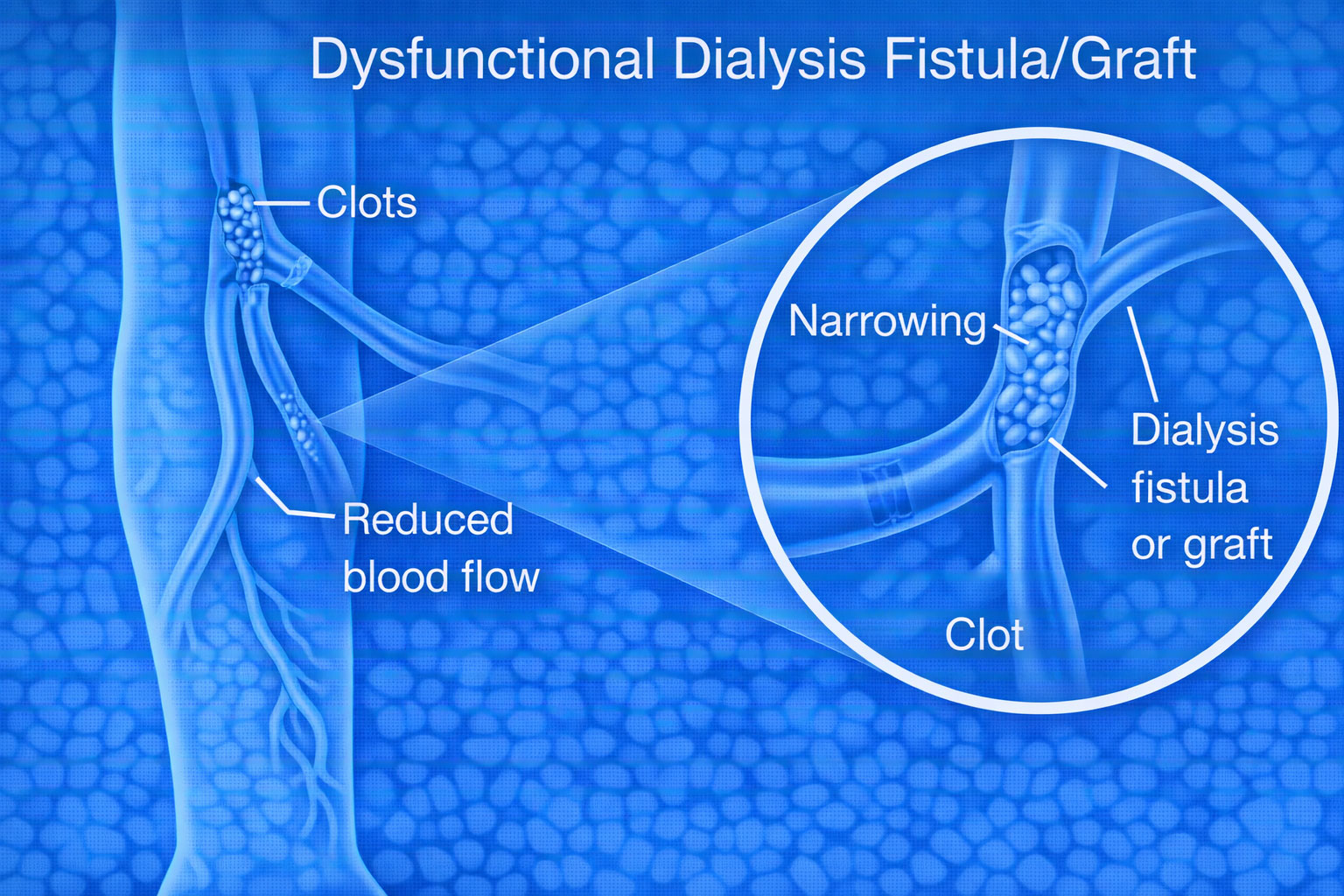 Dialysis Fistula Repair Chennai – Restore Access Fast