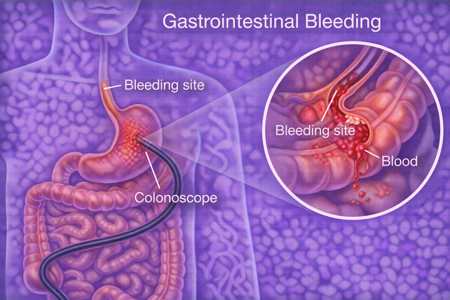 Gastrointestinal bleeding treatment chennai