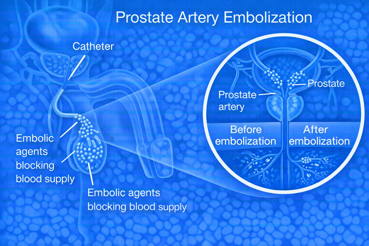 Prostate Artery Embolization Chennai – Relief for Enlarged Prostate