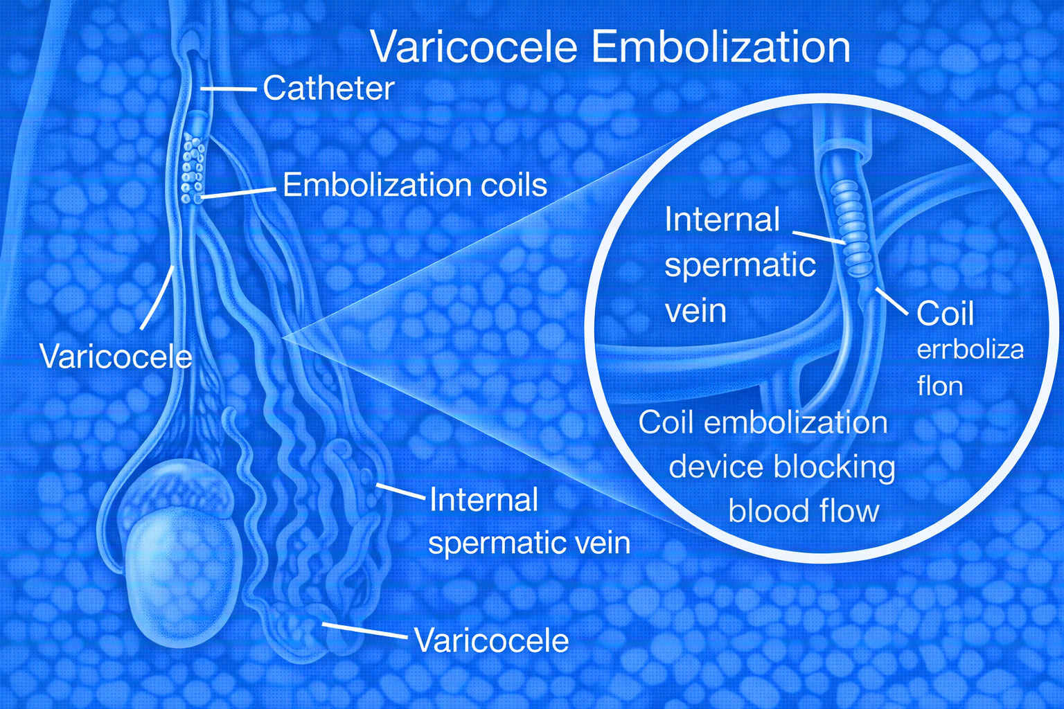 varicocele embolization chennai