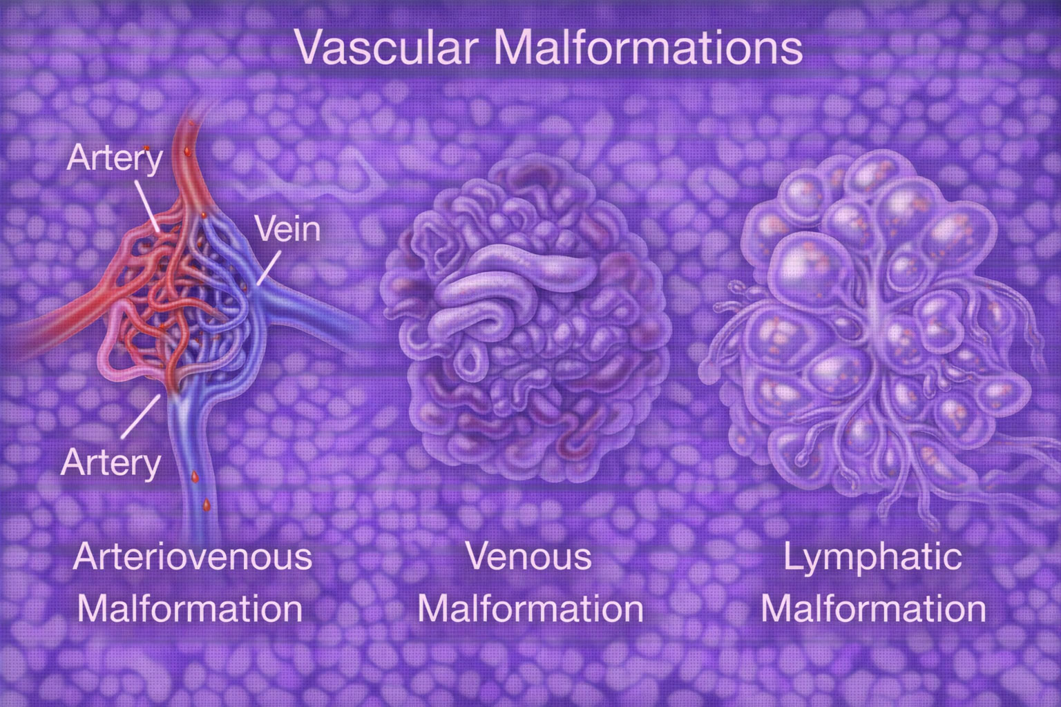 vascular malformation treatment chennai