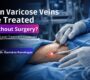 Can Varicose Veins Be Treated Without Surgery EVLT Explained 90x80