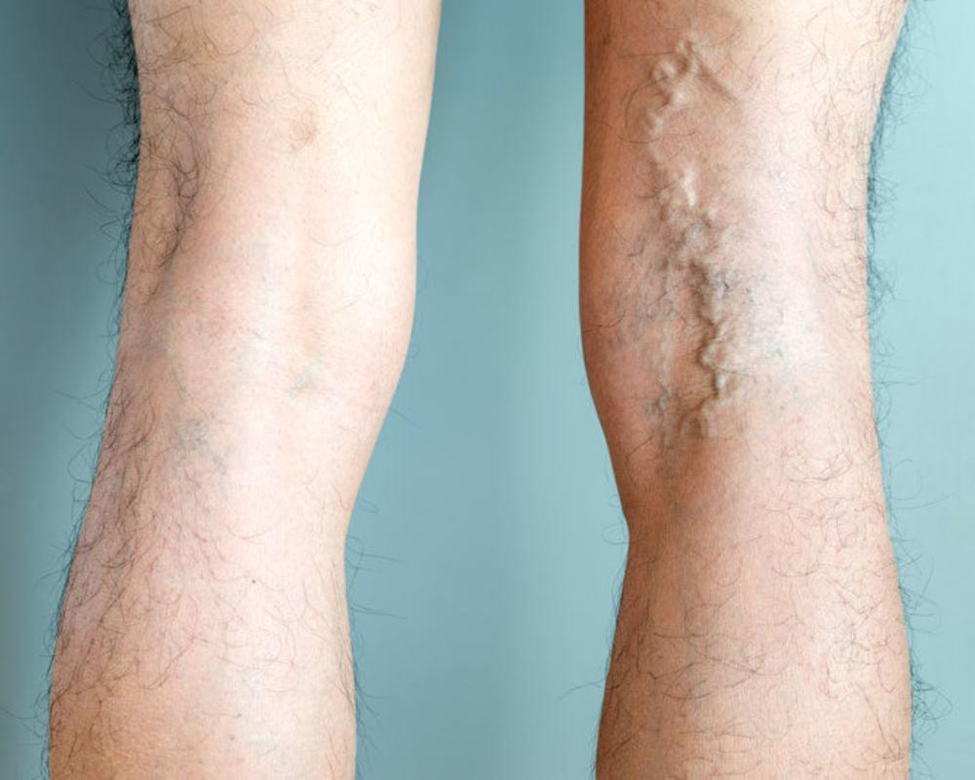 Varicose Vein Treatment Without Surgery EVLT laser fiber insertion under sterile surgical drape