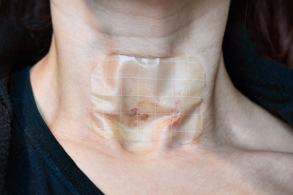 Post Procedure Instructions for Thyroid FNAC with small bandage on neck after biopsy