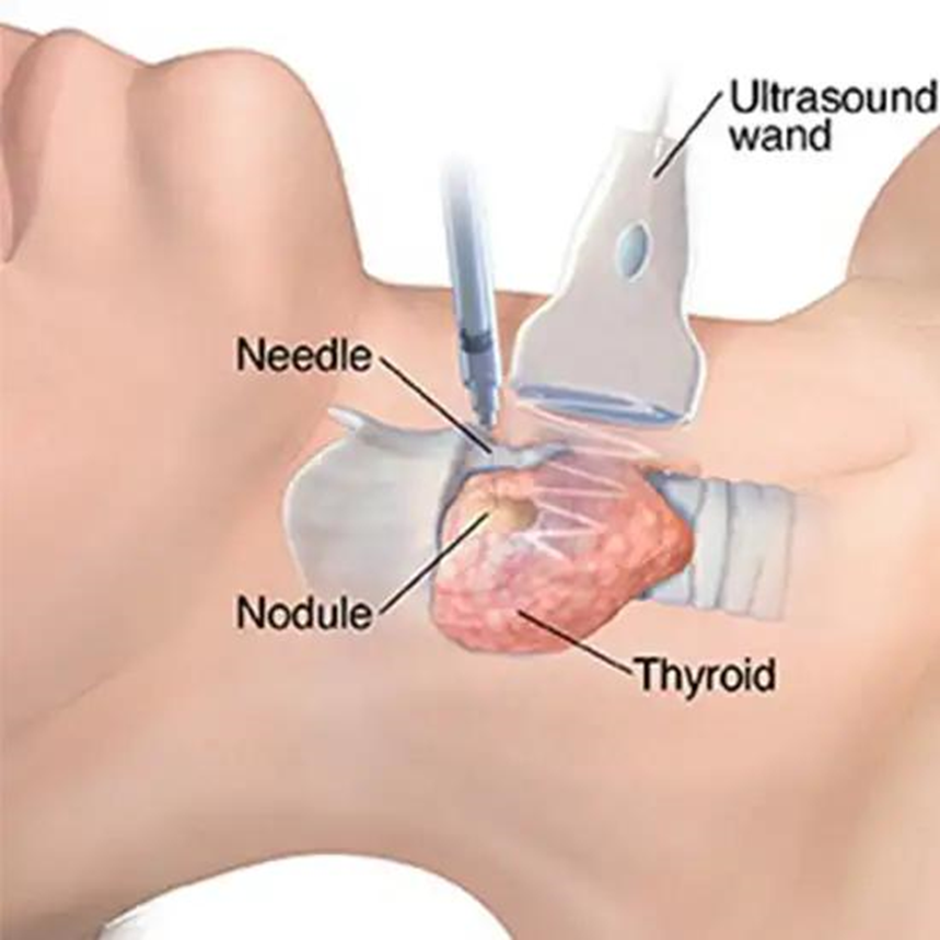 Thyroid FNAC recovery image showing clean biopsy site and proper aftercare
