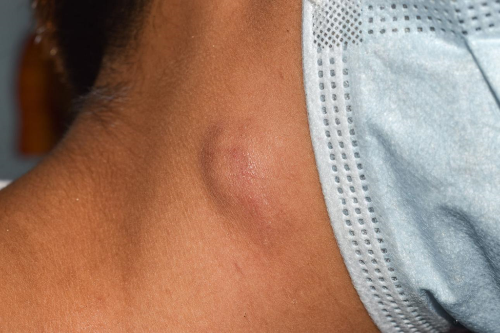 Clinical setting image of thyroid FNAC post procedure care and recovery guidance