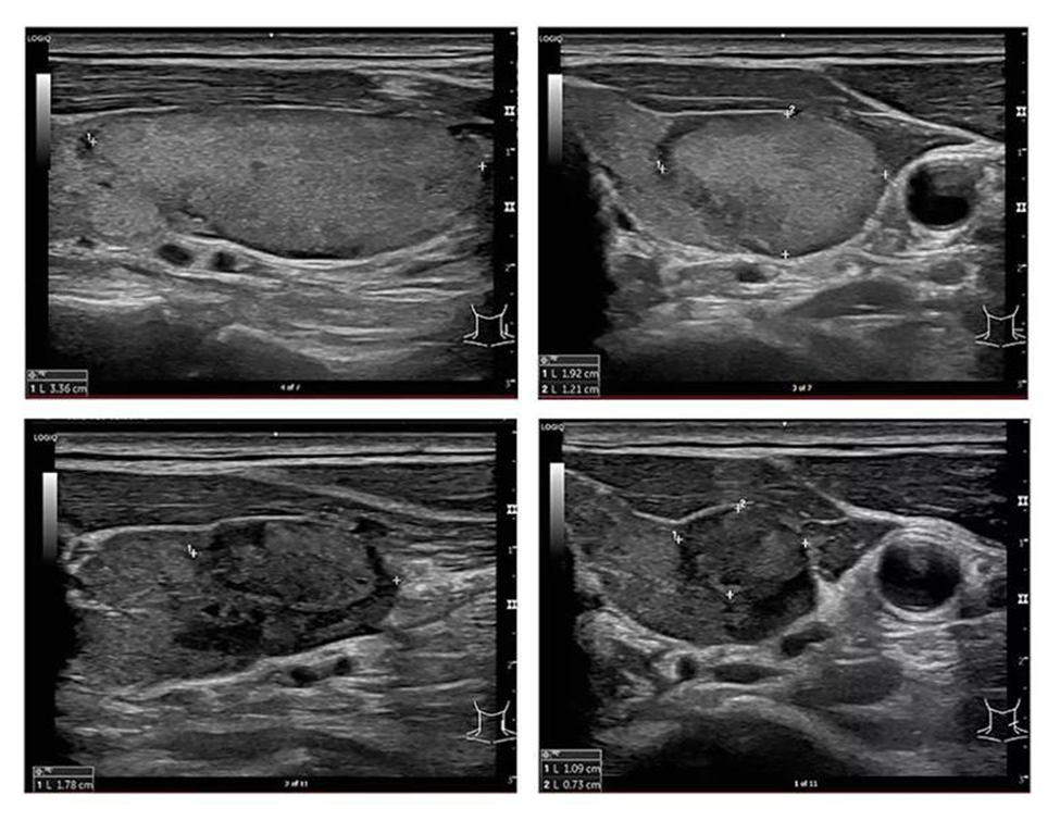 Clinical setting image of thyroid FNAC post procedure care and recovery guidance