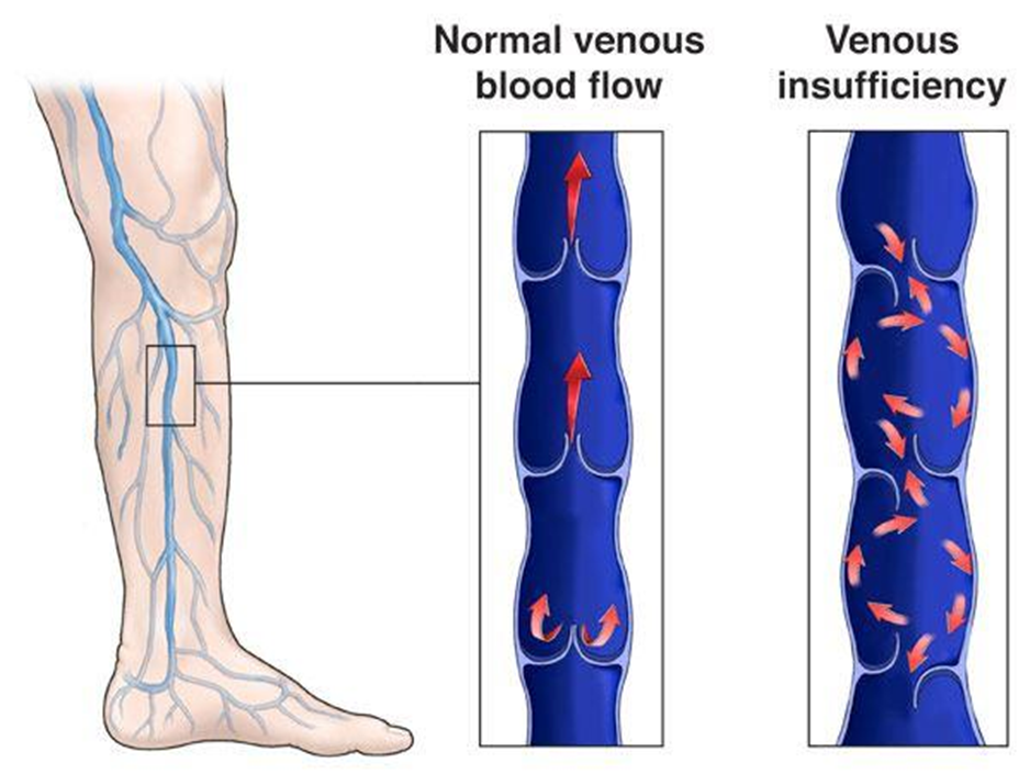 EVLT procedure for Varicose Vein Treatment Without Surgery showing catheter and medical equipment