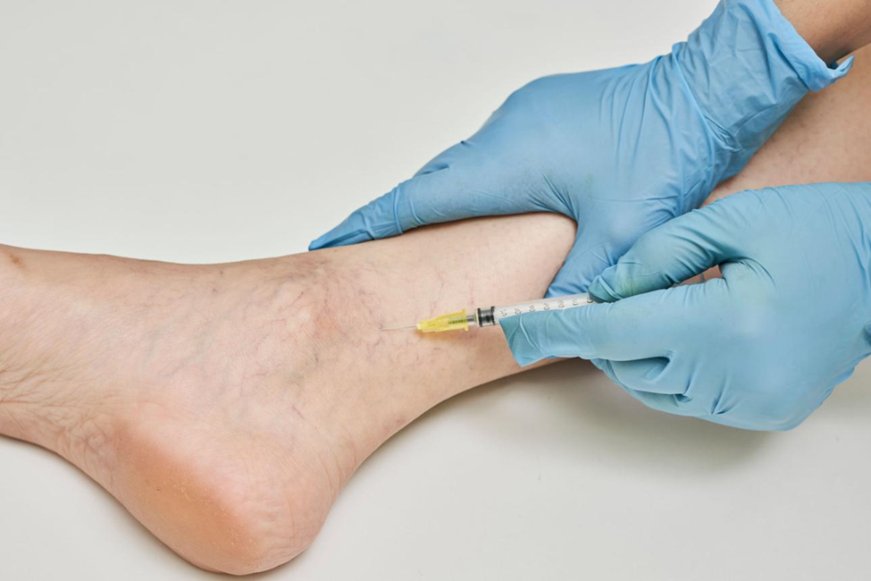 Minimally invasive Varicose Vein Treatment Without Surgery with laser catheter and ultrasound guidance