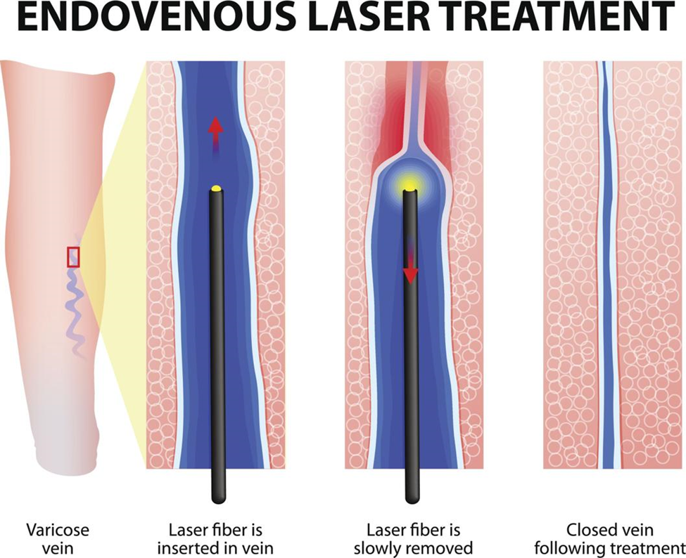 Precision EVLT laser device for Varicose Vein Treatment Without Surgery in operation theatre setting