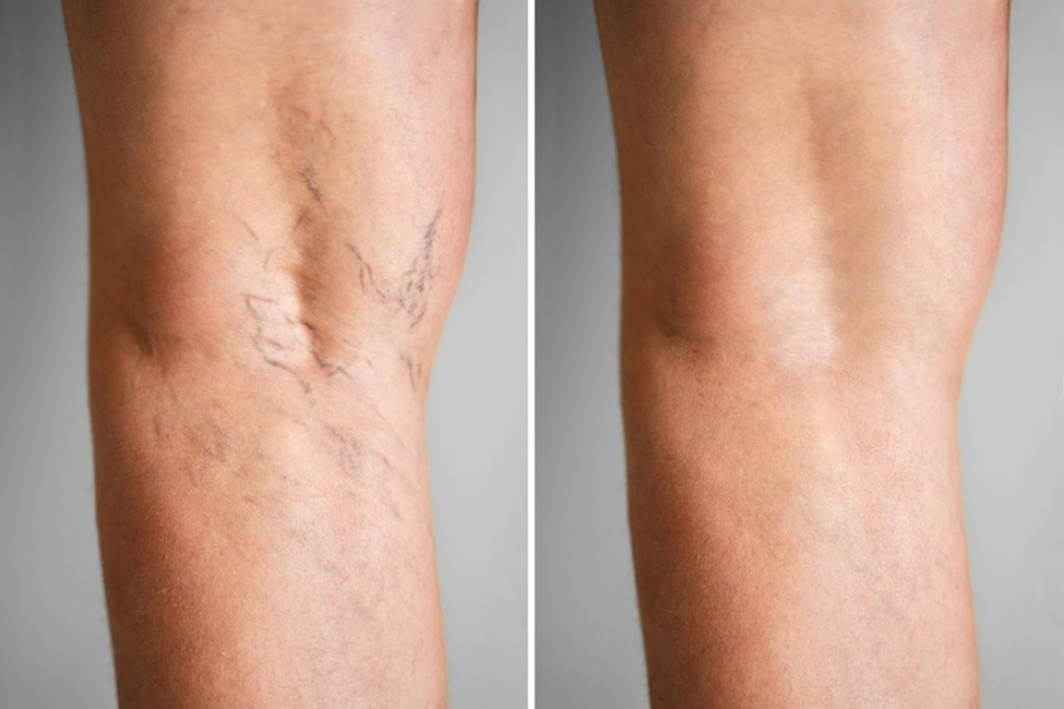 Minimally invasive Varicose Vein Treatment Without Surgery with laser catheter and ultrasound guidance