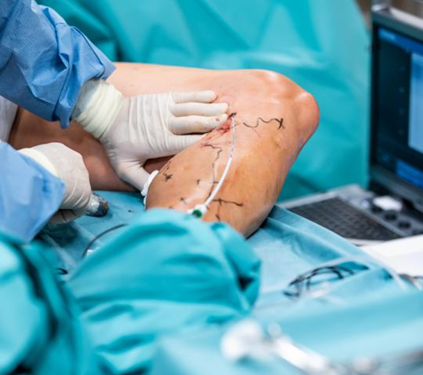 Endovenous Laser Treatment EVLT used for Varicose Vein Treatment Without Surgery close-up medical shot