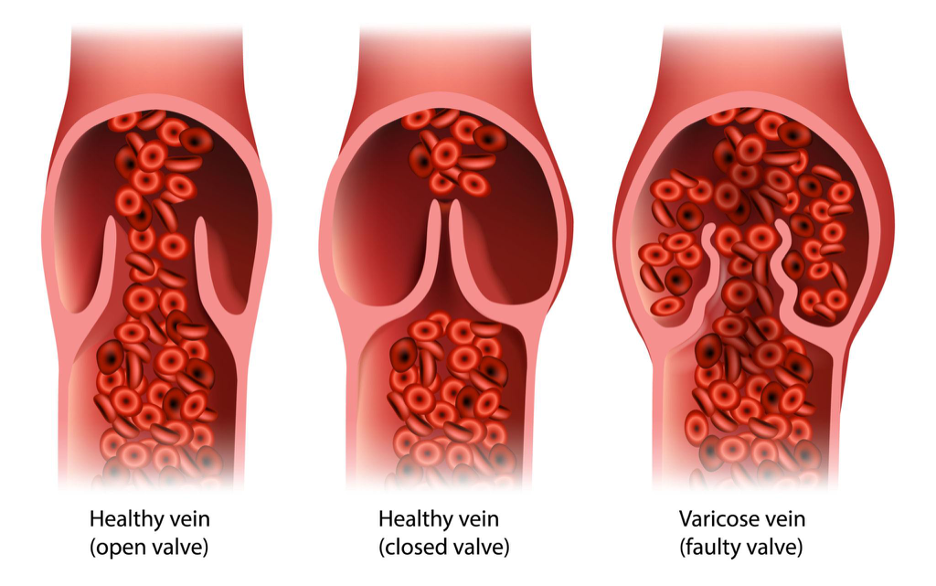 Varicose vein symptoms and treatment in Chennai clinic