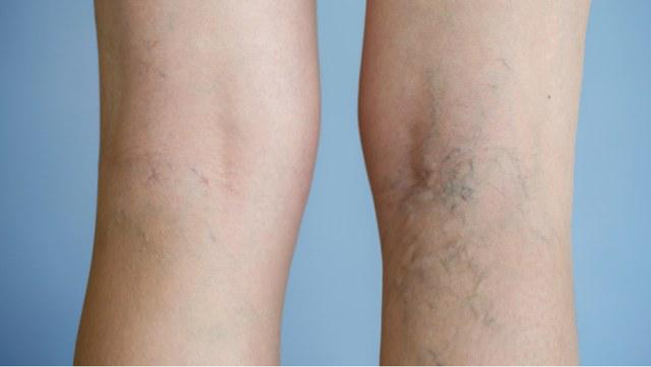 RFA treatment for varicose veins Chennai hospital