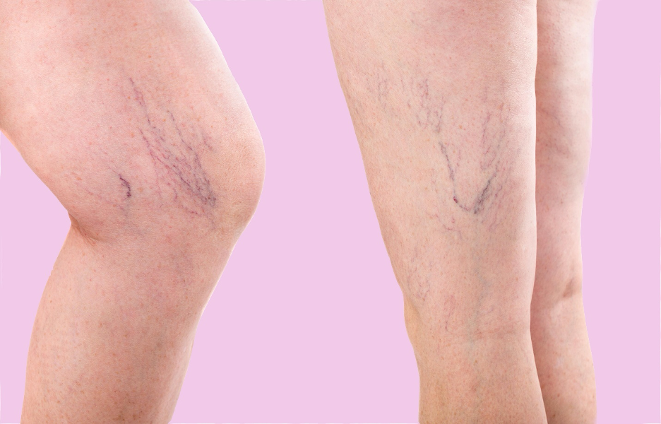 Signs of varicose veins in legs Chennai patients